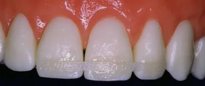 Чистка и отбеливание зубов фото до и после