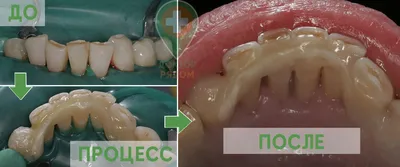 Реставрация зубов - цена на художественное восстановление зубов в СПб