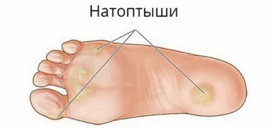 Стержневая мозоль, или шипица: причины, удаление - Клиника «ЛИЦ» —  современный медицинский центр в СПб
