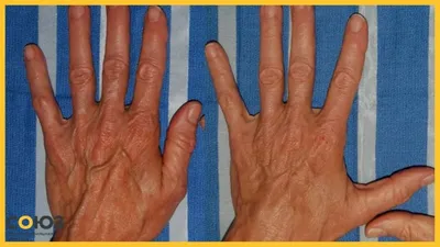 Повреждения / разрывы / отрывы сухожилий сгибателей и разгибателей пальцев  кисти – Травмы рук – Лечение и восстановление