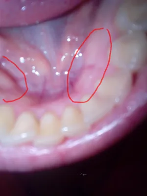 Твердые шишки на десне нижней челюсти внутри - Вопрос стоматологу - 03  Онлайн