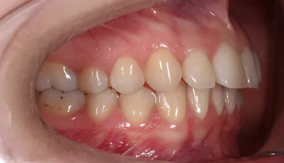 Протрузия зубов: причины и симптомы, методы диагностики, лечения и  профилактики - SHiFA