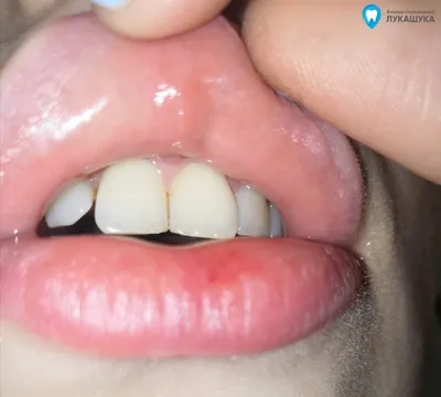 Шишка на десне внутри - Вопрос стоматологу - 03 Онлайн