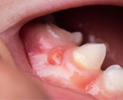 Шишка на десне после установки импланта - Полезные статьи на сайте  стоматологической клиники Церекон