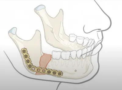 Зубной свищ на десне: причины, симптомы и лечение в стоматологической  клинике
