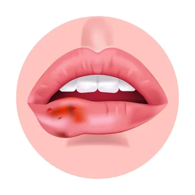 Уплотнение на нижней челюсти внутри - Вопрос стоматологу - 03 Онлайн