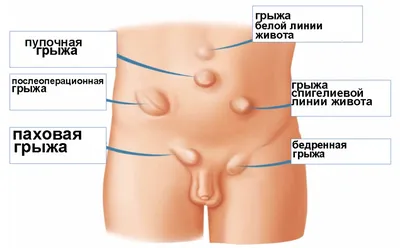 Удаление паховой грыжи