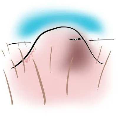 Как понять, что шишка под кожей похожа на опухоль | Для пациентов | Дзен