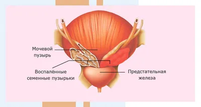 Везикулит: симптомы, диагностика, лечение острой и хронической формы