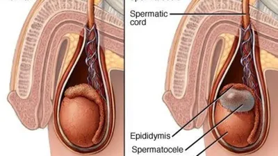 Сперматоцеле: Киста придатка яичка у мужчин - лечение в Украине | Клиника  Биляка