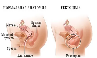 Что такое геморрой и как его лечить? | Статьи медицинского центра доктора  Бегмы