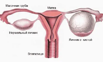 Папилломы на гениталиях - как вести половую жизнь с ВПЧ? | Лазерсвiт в  Харькове