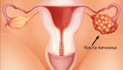 Почему образуется грыжа и как её лечить — блог медицинского центра ОН Клиник