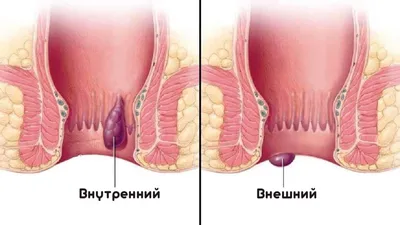 Карбункул – симптомы, причины, диагностика и лечение болезни кожи у  взрослых | «Будь Здоров»