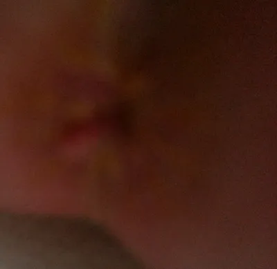 У новорожденного на анальном отверстии розовая шишечка - Вопрос детскому  хирургу - 03 Онлайн