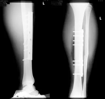 Перелом большеберцовой кости или как я ногу сломал. Часть 2. Операция. |  Пикабу