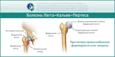 Перелом костей голени