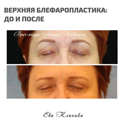 Блефаропластика верхних век | Статьи клиники Major Beauty