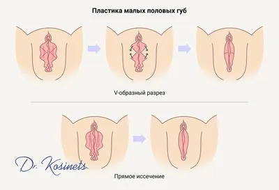 ICSI Clinic ≋ Как проходит процесс заживления после лабиопластики? |  Клініка репродуктивного здоров'я