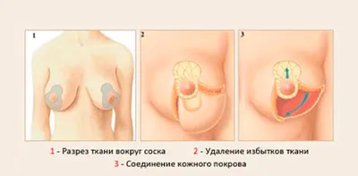 Лабиопластика - Цена операции, сделать пластику половых губ в Минске