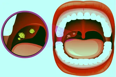 Ангина: гнойная, фолликулярная, фото, симптомы, лечение
