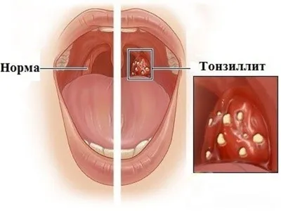 Хронический тонзиллит - лечение у взрослых и детей, симптомы тонзиллита,  диагностика | Клиника МедПросвет