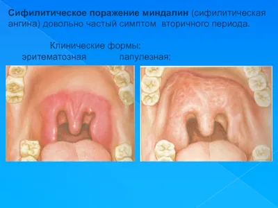 Презентация \"Дифференциальная диагностика ангин\" по медицине – скачать  проект