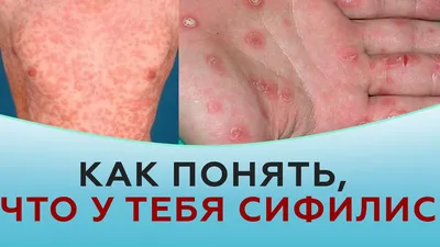 ᐈ Базалиома (базальноклеточный рак кожи) ~【Лечение в Киеве】