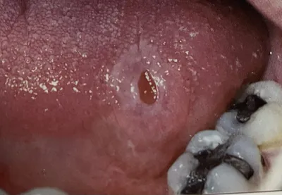 Сифилис- инфекционное поражение. Как выглядит сифилис в полости рта... |  Dental Plats - стоматология СПБ | Дзен