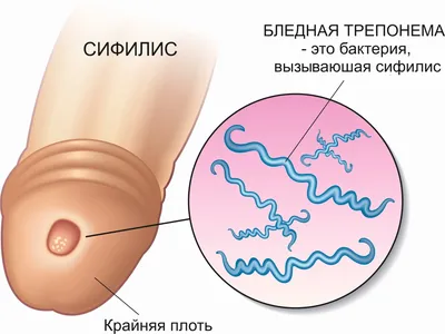 🏥 КЛИНИКА ЧАСТНАЯ ПРАКТИКА on Instagram: \"Первое проявление сифилиса - это  твердый шанкр, эрозия или язва, образующаяся в месте внедрения возбудителя  сифилиса бледной трепонемы через 3-4 недели после заражения. Кроме  типичного твердого