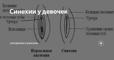 Синехия (сращение) малых половых губ с картинками