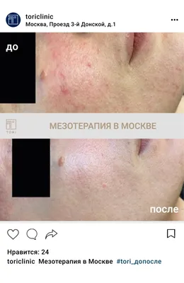 Косметолог💉Катя Могильницкая on Instagram: \"СТРАШНЫЙ ВОПРОС😱 СИНЯКИ ПОСЛЕ  ИНЪЕКЦИЙ Наверное каждый пациент, который прибегал к услугам инъекционной  косметологии, сталкивался с таким вопросом как проявление синяков после  уколов красоты💉 Многие ...