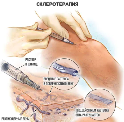 Склеротерапия вен нижних конечностей / Флеболог / Услуги /  Лечебно-диагностический центр МедЭксперт Саратов / Энгельс