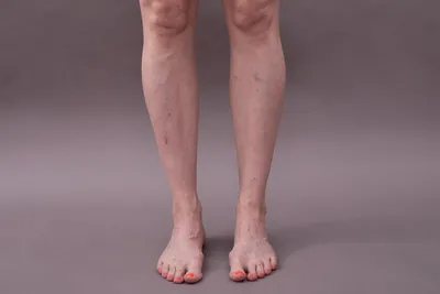 Удаление вен на ногах - как это делают? | Beauty Insider