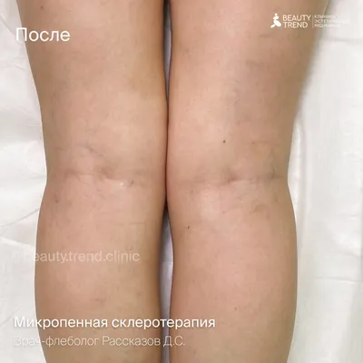 Микропенная склеротерапия в Москве по цене от 9000 руб. в клинике Beauty  Trend