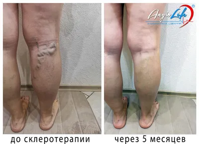 Результаты склеротерапии | Фото до и после лечения вен