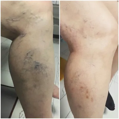 Фото до и после лечения варикозной болезни нижних конечностей с помощью  склеротерапии – Петр Александрович Пироженко