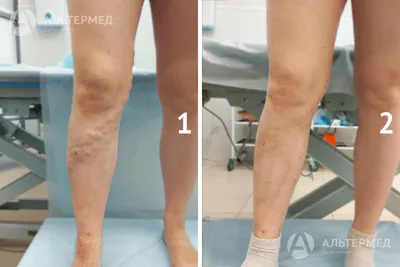 Как выглядит нога до и после склеротерапии | Центр Флебологии | Дзен