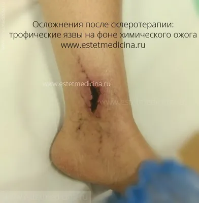 Склеротерапия вен нижних конечностей в Москве | «Бест Клиник»