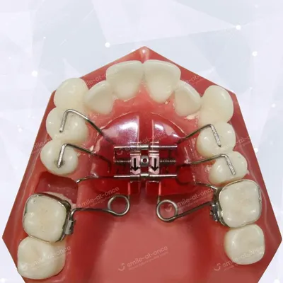 Ортодонтические пластинки: показания, преимущества. Стоматология  Smile-at-Once в Москве.