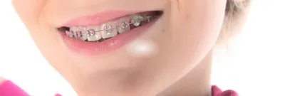 стоматологическая скоба | www.smileofthesun.su