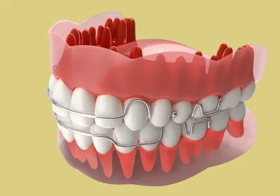 Пластинка на зубы – цена ортодонтических зубных пластин в Киеве в ID Dent