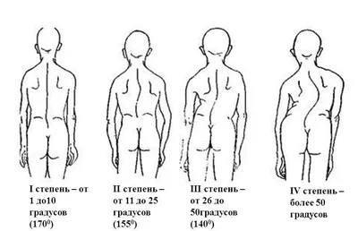 Гимнастика, ЛФК и комплекс лечебных упражнений при сколиозе