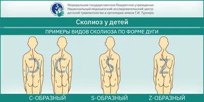 Левосторонний сколиоз позвоночника: признаки, степени и лечение