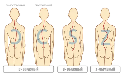 Сколиоз, виды искривления позвоночника у детей и взрослых, лечение сколиоза  в Москве