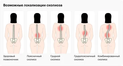 Сколиоз у детей — причины, виды, правильная диагностика сколиоза у ребенка  - Национальный медицинский исследовательский центр детской травматологии и  ортопедии имени Г. И. Турнера - официальный сайт