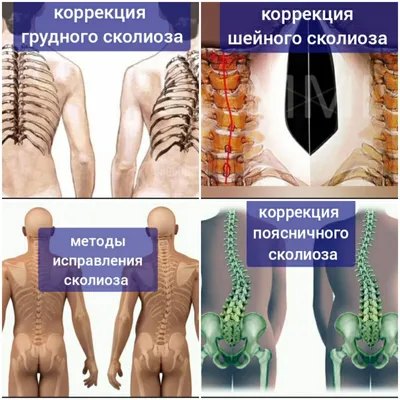 Сколиоз – факты. Двухмерная модель против трёхмерной, часть I | Массаж.ру