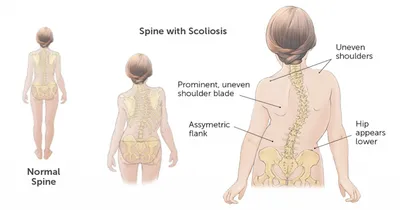 СКОЛИОЗ позвоночника 1, 2, 3 и 4 степени у детей и взрослых - симптомы,  причины, диагностика | Mednavigator.ru | Дзен