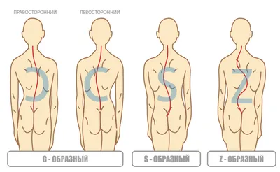 Идиопатический сколиоз — эффективные методы консервативного и  хирургического лечения у детей и подростков -