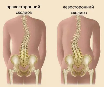 Сколиоз у ребёнка и взрослого. К какому врачу обращаться при сколиозе?  Симптомы, методы диагностики и лечение сколиоза